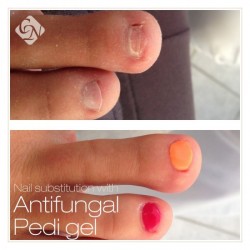 PEDI Antifungal UV Gel _15ml